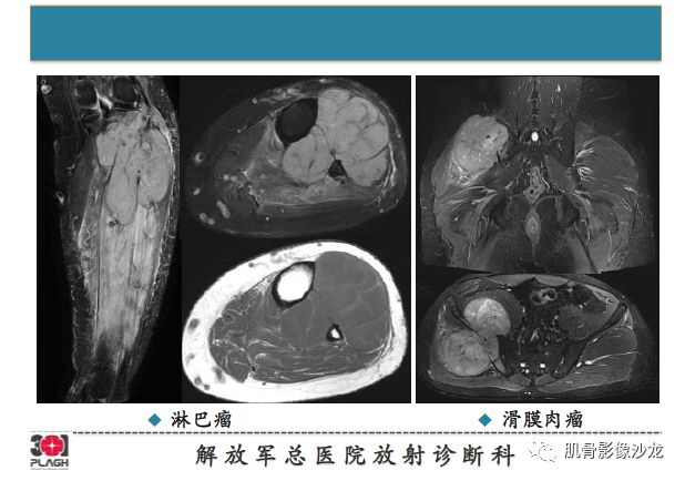 【PPT】软组织肿瘤磁共振诊断分析思路