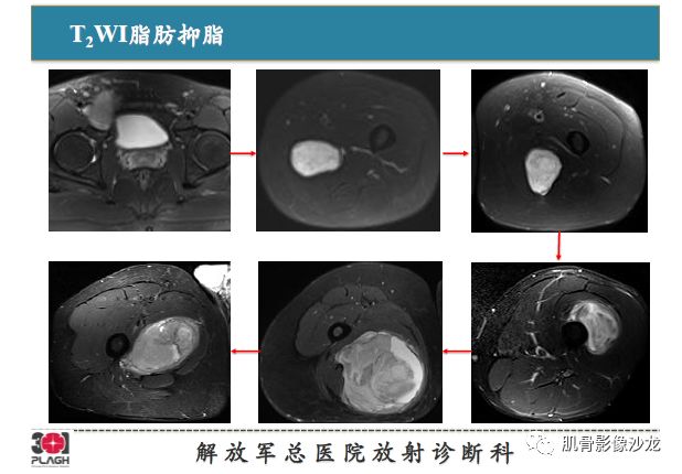 【PPT】软组织肿瘤磁共振诊断分析思路