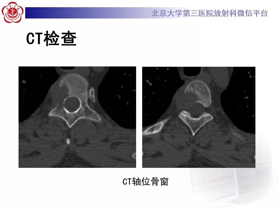 【病例】胸椎朗格汉斯组织细胞增生症1例CT及MR