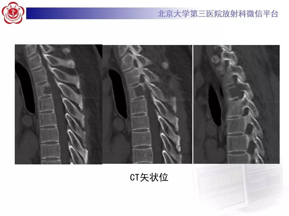 【病例】胸椎朗格汉斯组织细胞增生症1例CT及MR