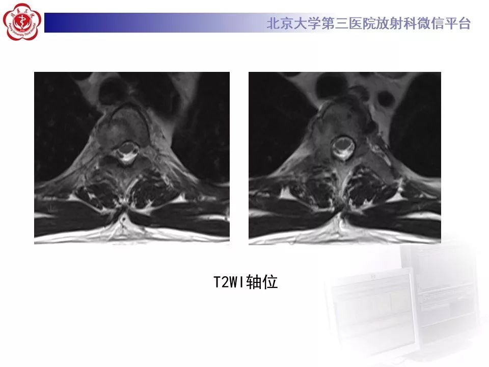 【病例】胸椎朗格汉斯组织细胞增生症1例CT及MR