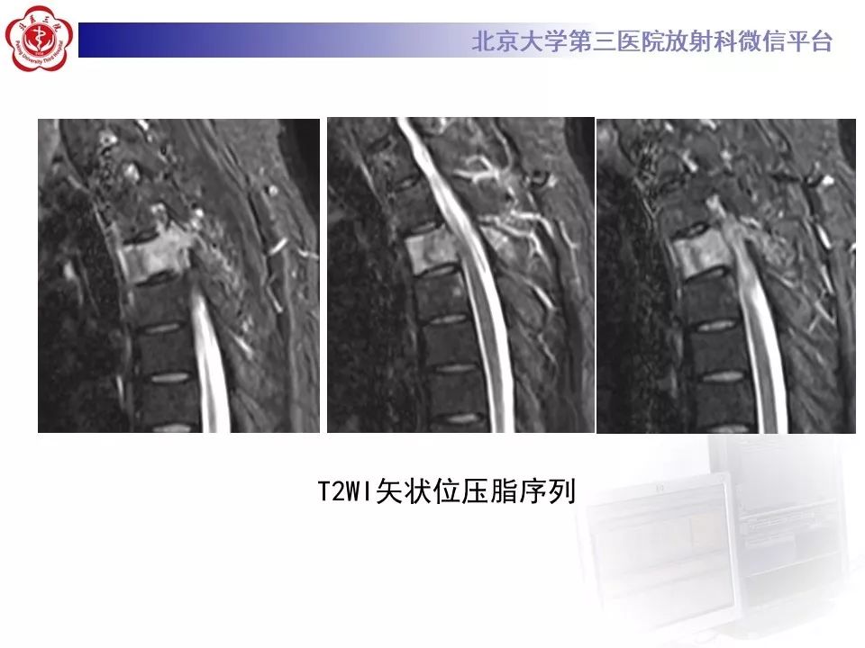 【病例】胸椎朗格汉斯组织细胞增生症1例CT及MR