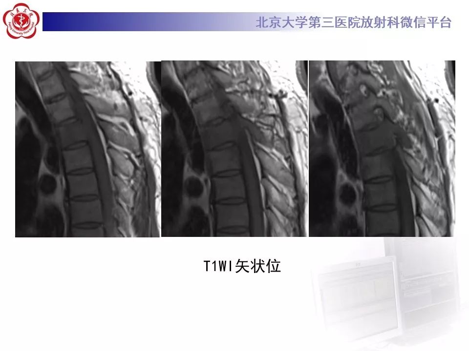 【病例】胸椎朗格汉斯组织细胞增生症1例CT及MR