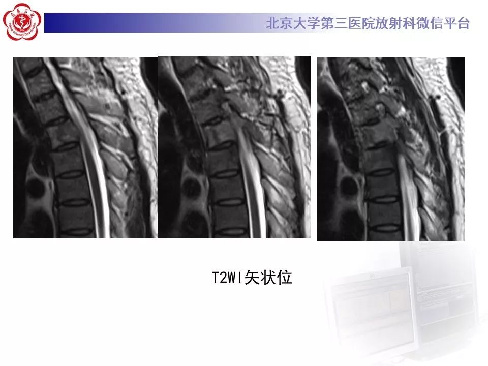 【病例】胸椎朗格汉斯组织细胞增生症1例CT及MR