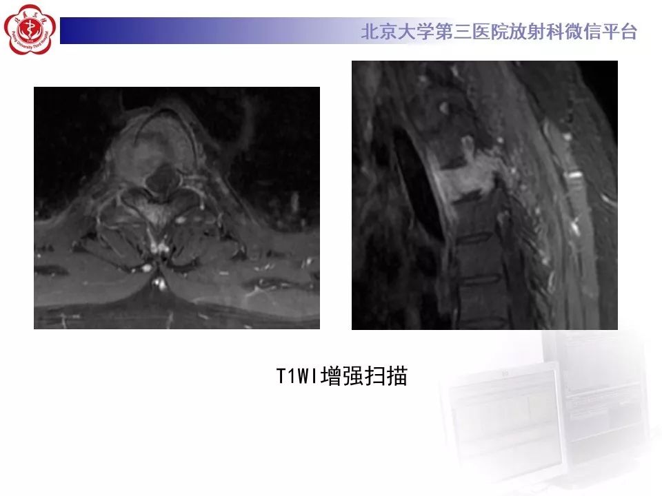 【病例】胸椎朗格汉斯组织细胞增生症1例CT及MR