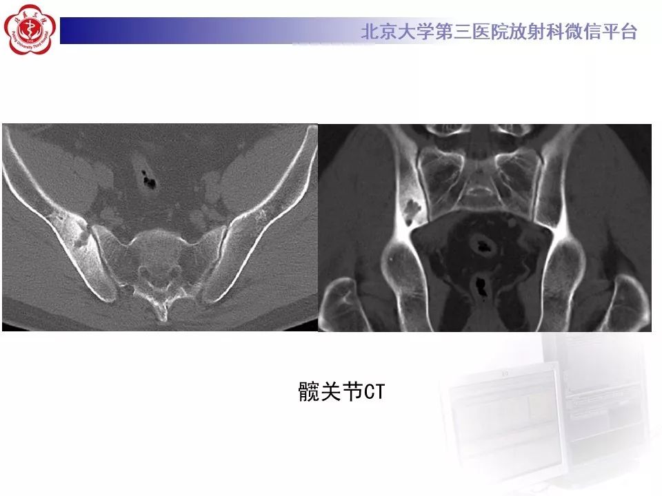 【病例】胸椎朗格汉斯组织细胞增生症1例CT及MR