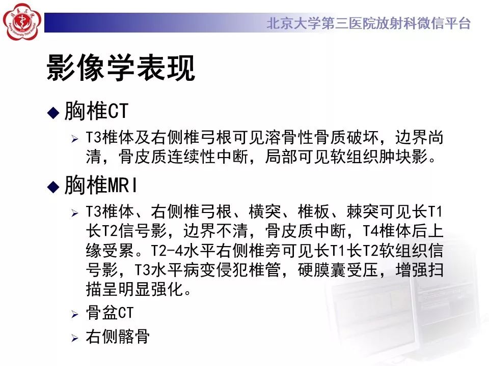 【病例】胸椎朗格汉斯组织细胞增生症1例CT及MR