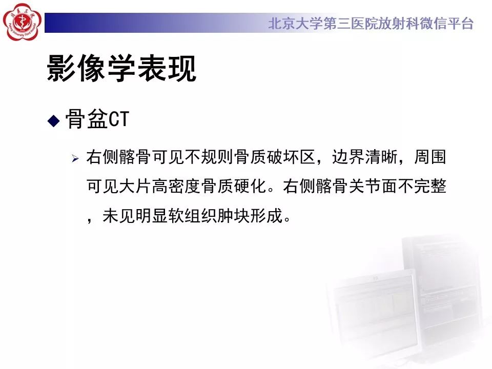 【病例】胸椎朗格汉斯组织细胞增生症1例CT及MR