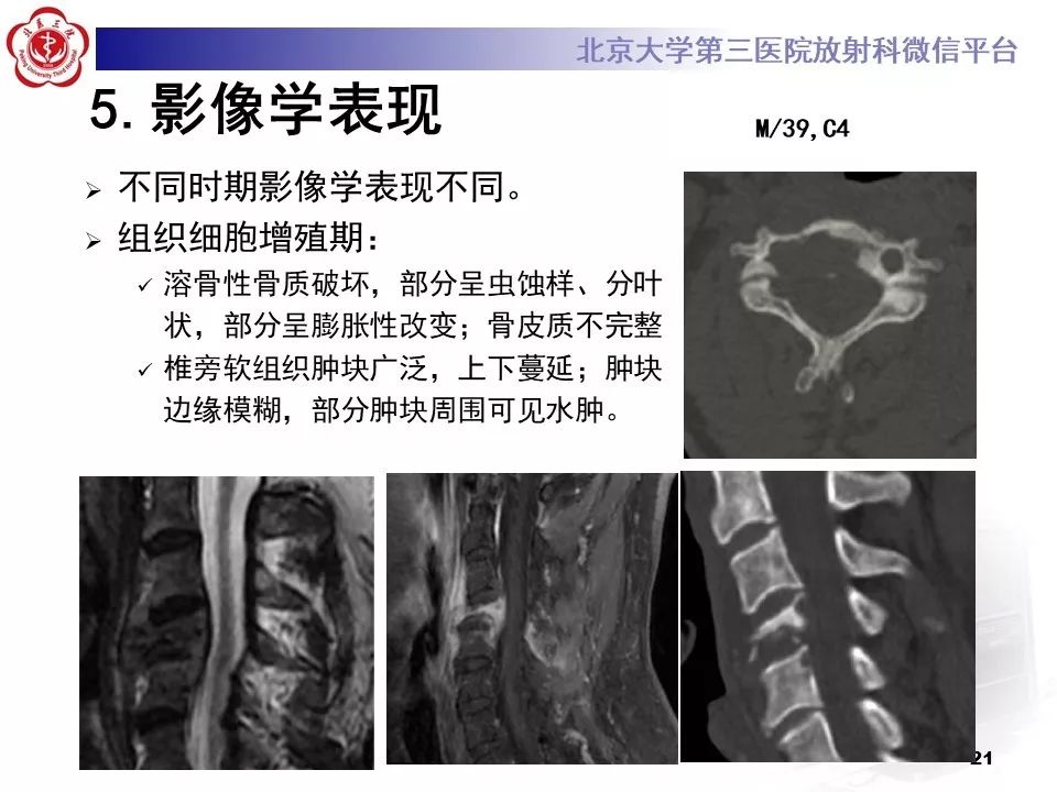 【病例】胸椎朗格汉斯组织细胞增生症1例CT及MR