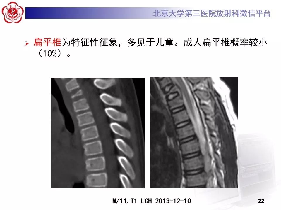 【病例】胸椎朗格汉斯组织细胞增生症1例CT及MR