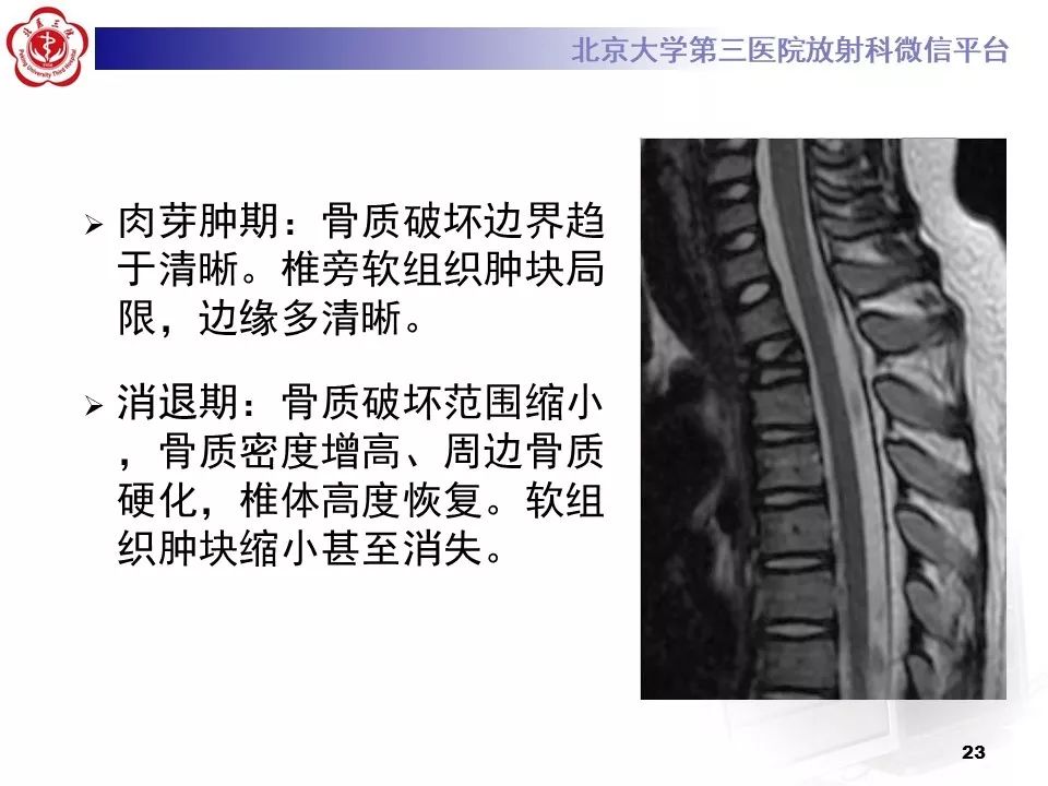【病例】胸椎朗格汉斯组织细胞增生症1例CT及MR