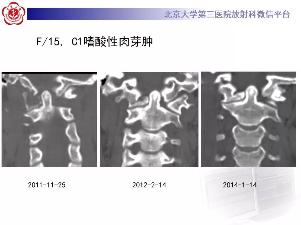 【病例】胸椎朗格汉斯组织细胞增生症1例CT及MR
