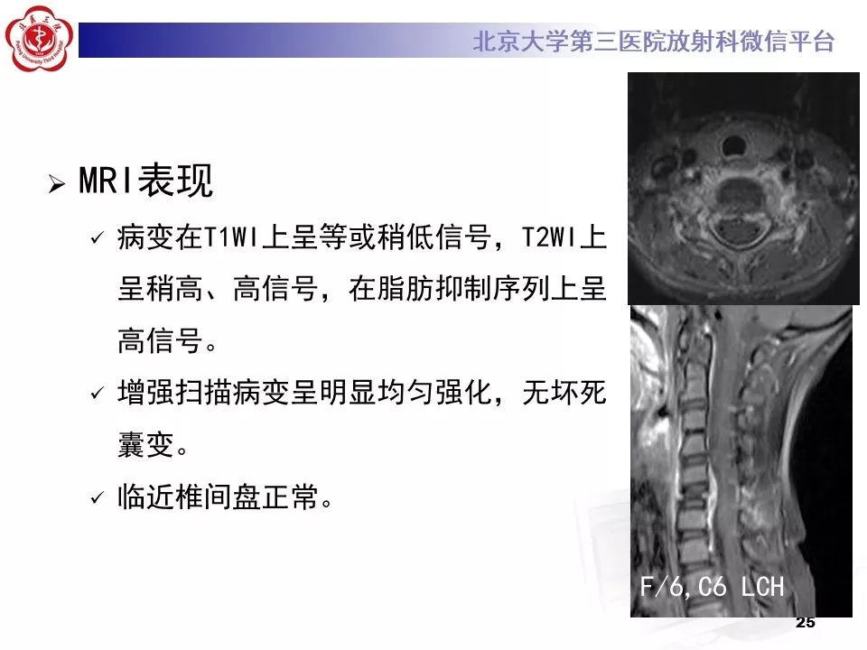 【病例】胸椎朗格汉斯组织细胞增生症1例CT及MR