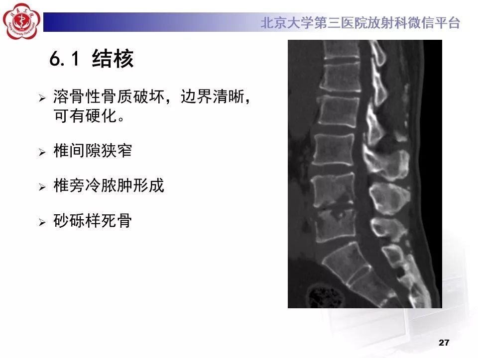 【病例】胸椎朗格汉斯组织细胞增生症1例CT及MR