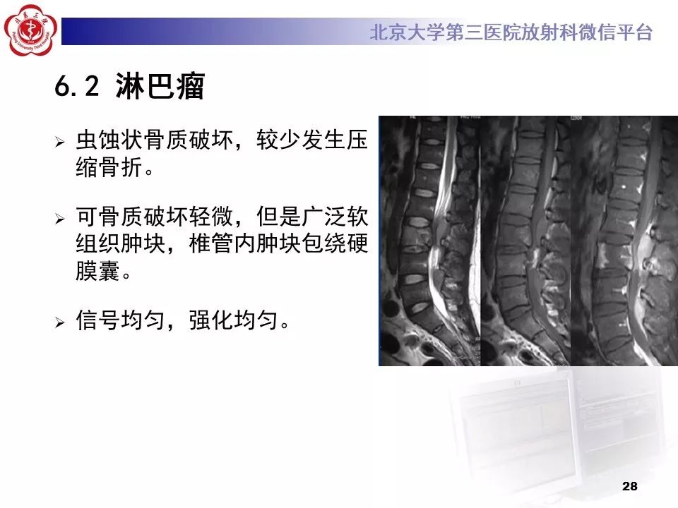 【病例】胸椎朗格汉斯组织细胞增生症1例CT及MR