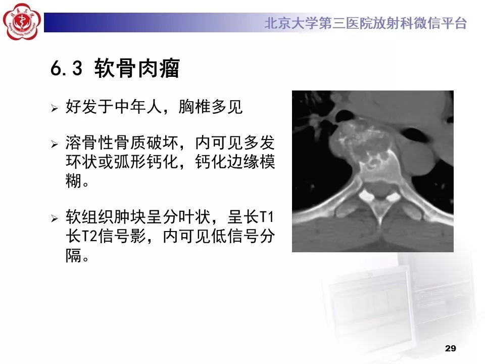 【病例】胸椎朗格汉斯组织细胞增生症1例CT及MR