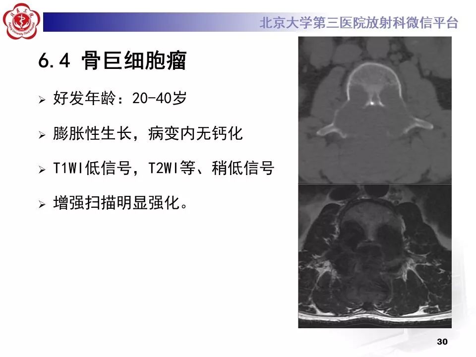 【病例】胸椎朗格汉斯组织细胞增生症1例CT及MR