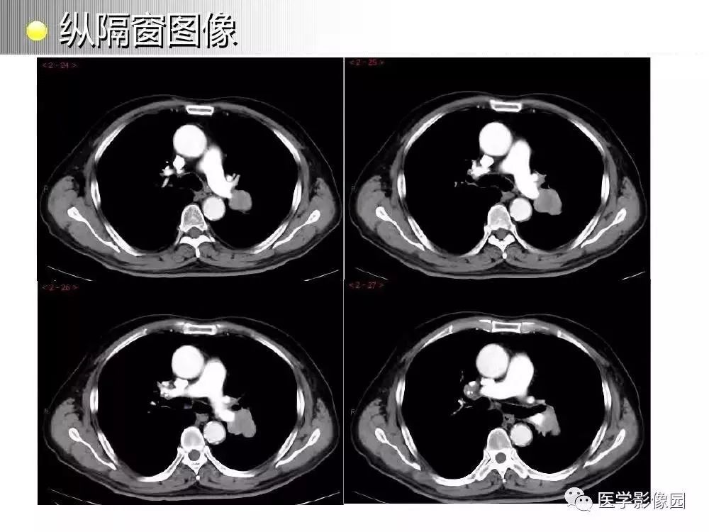 【病例】左肺门巨大淋巴结增生症1例CT