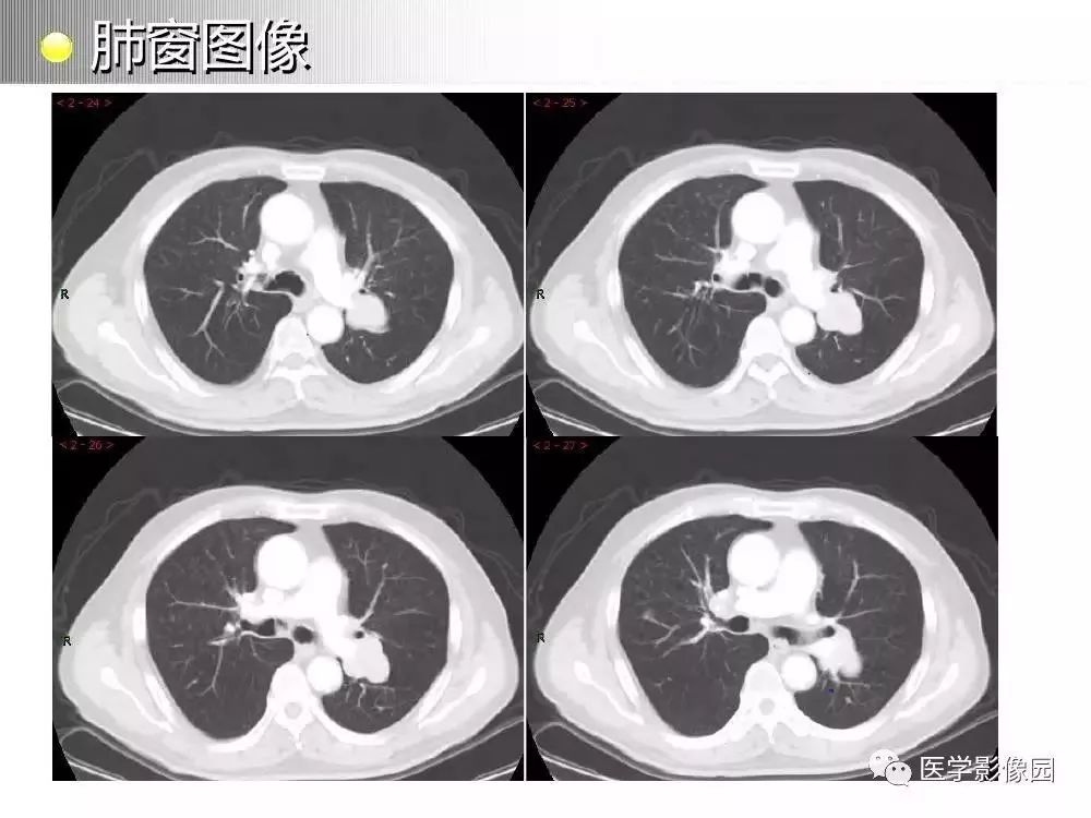 【病例】左肺门巨大淋巴结增生症1例CT