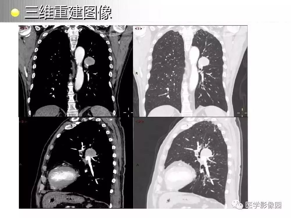 【病例】左肺门巨大淋巴结增生症1例CT