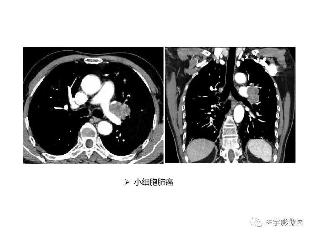 【病例】左肺门巨大淋巴结增生症1例CT