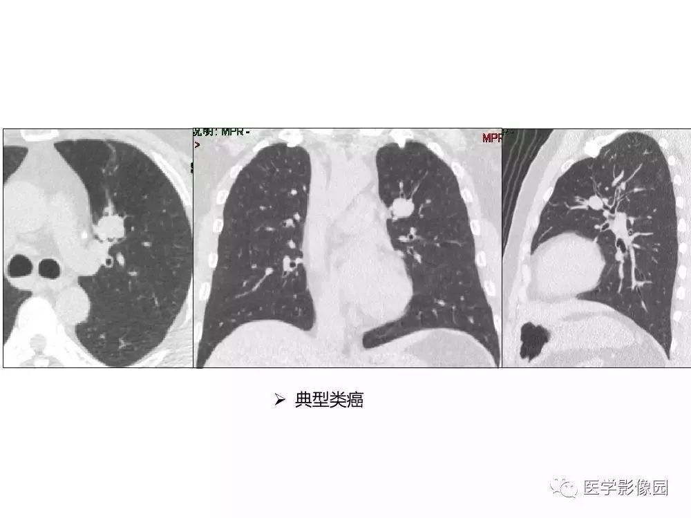 【病例】左肺门巨大淋巴结增生症1例CT