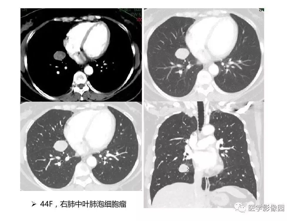 【病例】左肺门巨大淋巴结增生症1例CT