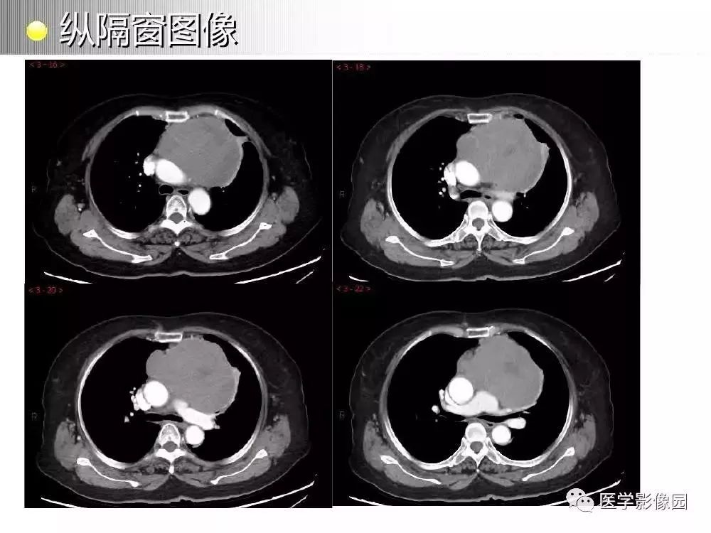 【病例】左肺门巨大淋巴结增生症1例CT