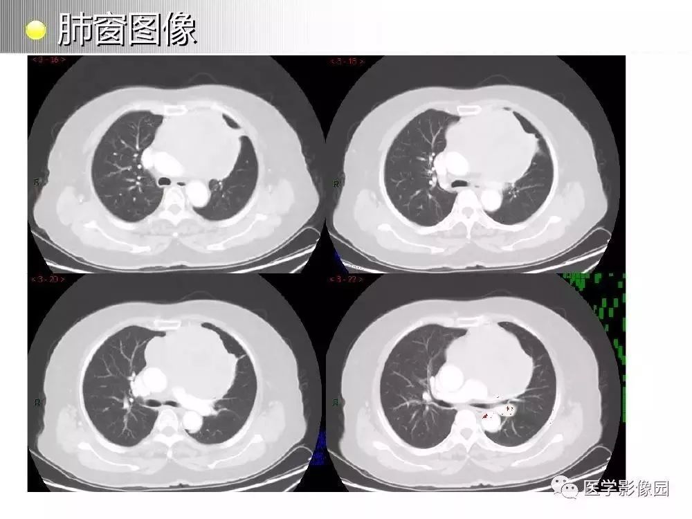 【病例】左肺门巨大淋巴结增生症1例CT