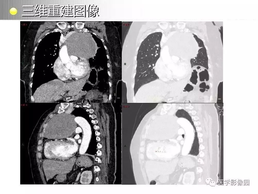 【病例】左肺门巨大淋巴结增生症1例CT