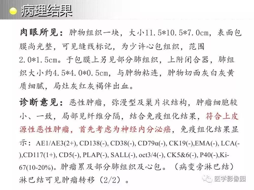 【病例】左肺门巨大淋巴结增生症1例CT