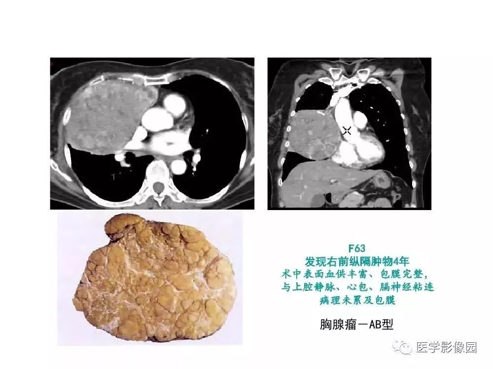 【病例】左肺门巨大淋巴结增生症1例CT