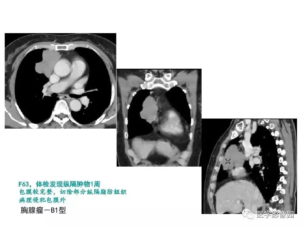 【病例】左肺门巨大淋巴结增生症1例CT