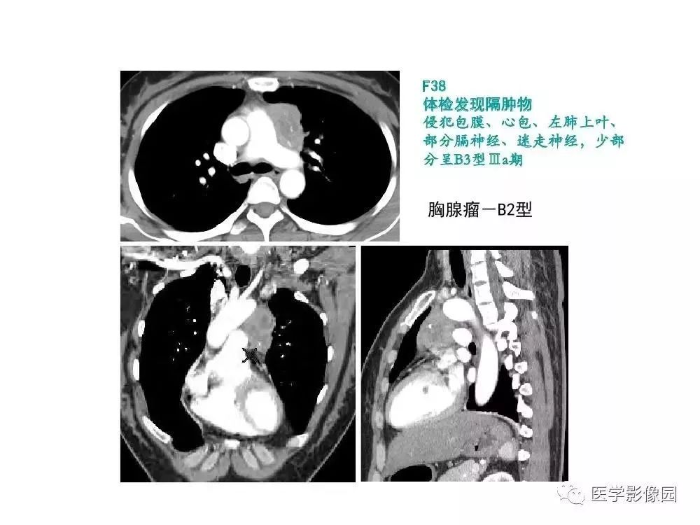 【病例】左肺门巨大淋巴结增生症1例CT