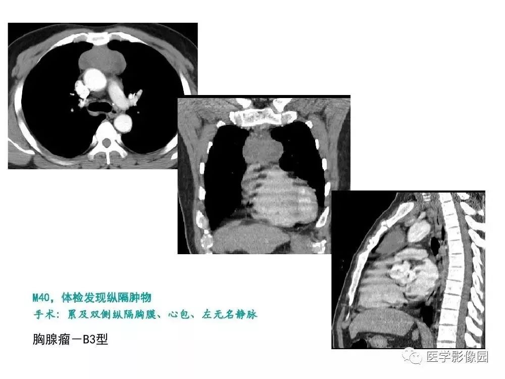 【病例】左肺门巨大淋巴结增生症1例CT