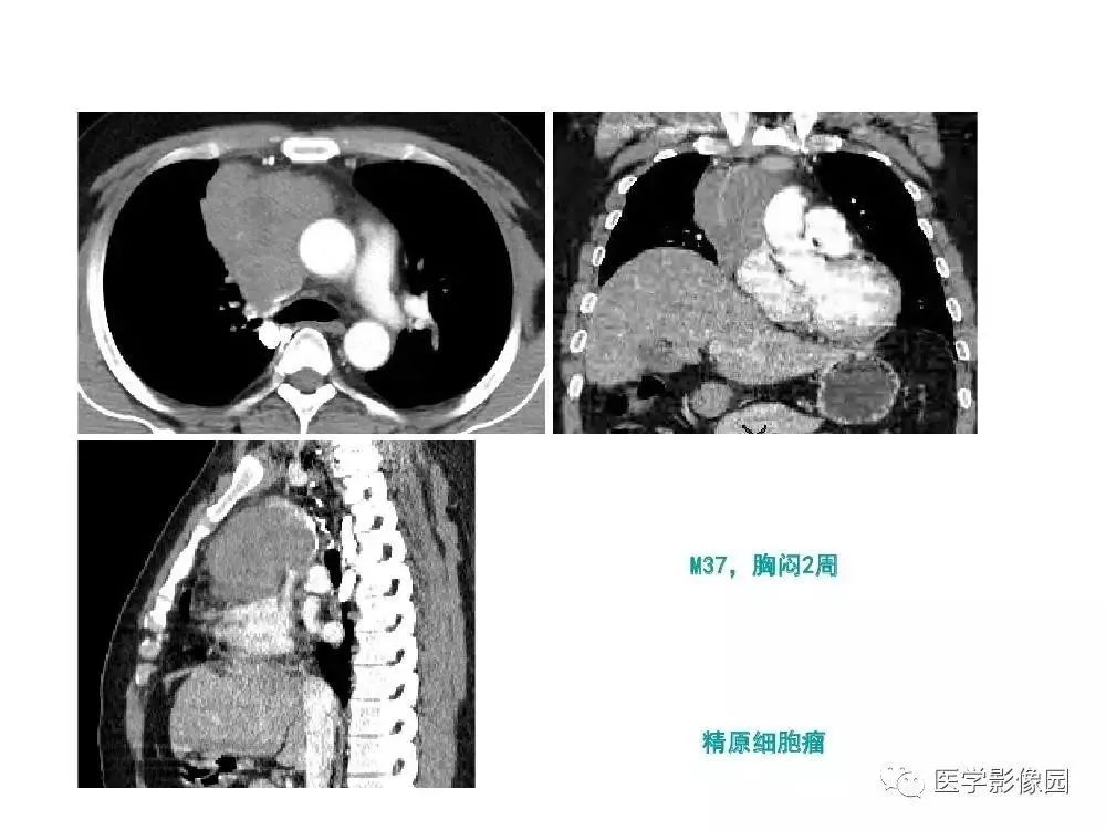【病例】左肺门巨大淋巴结增生症1例CT