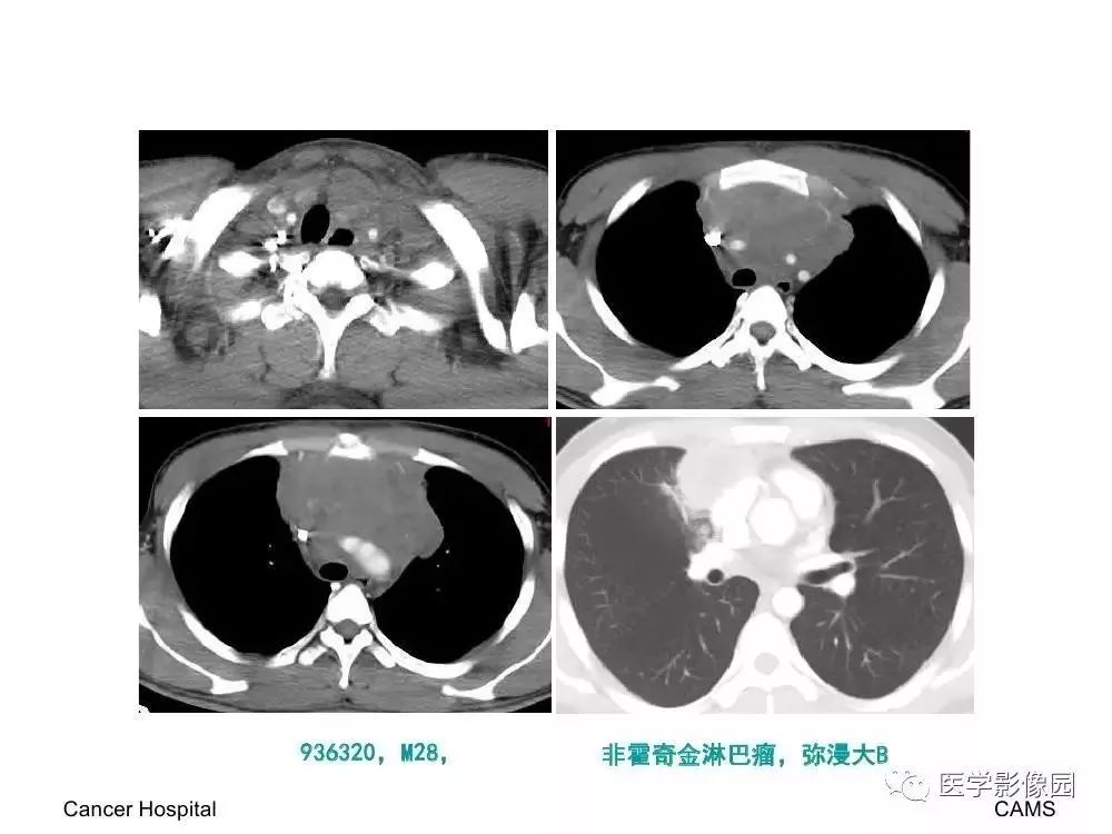 【病例】左肺门巨大淋巴结增生症1例CT
