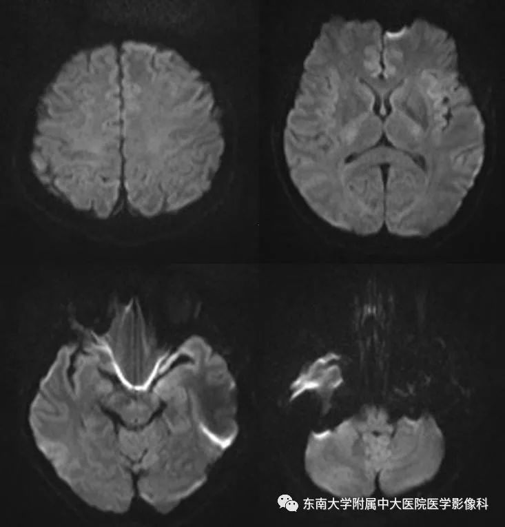 【病例】可逆性脑血管收缩综合征1例MR
