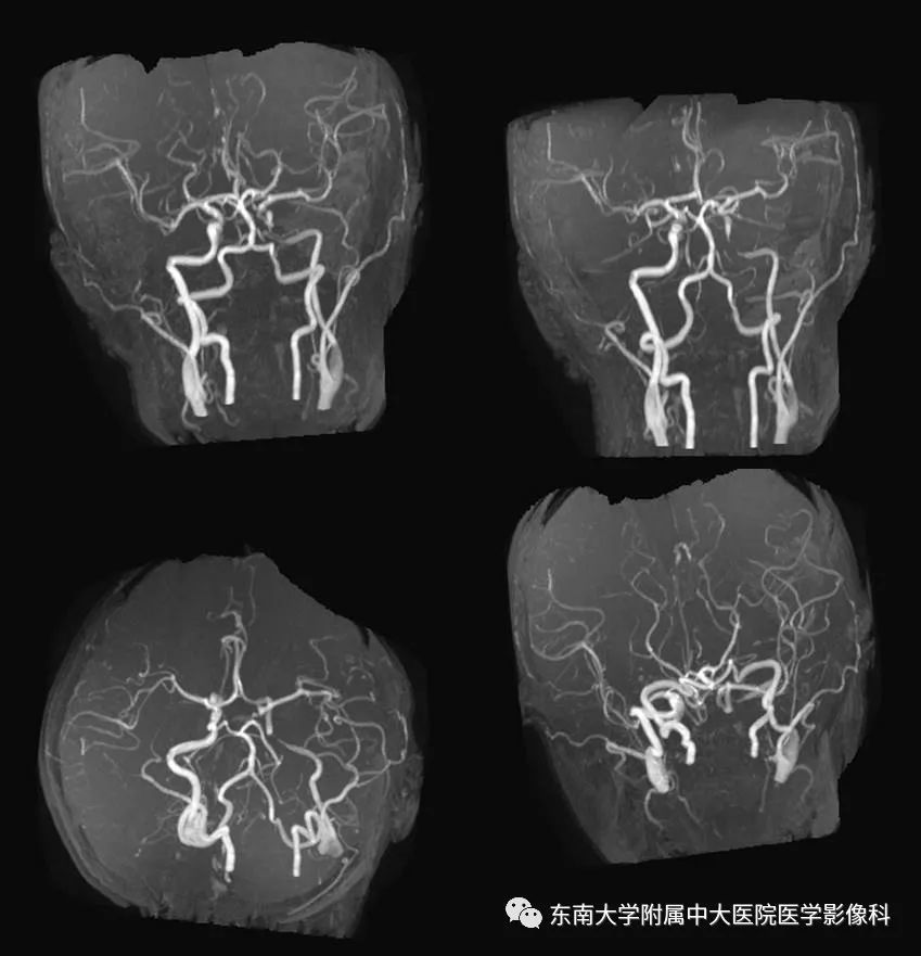 【病例】可逆性脑血管收缩综合征1例MR