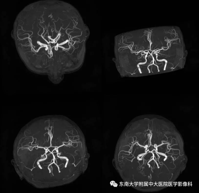 【病例】可逆性脑血管收缩综合征1例MR