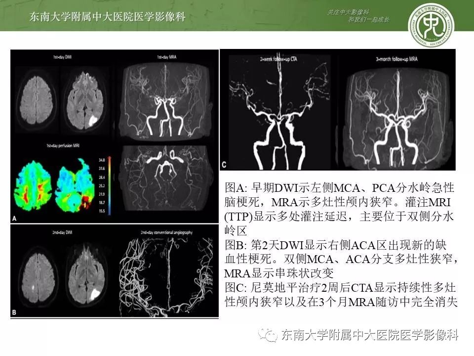 【病例】可逆性脑血管收缩综合征1例MR