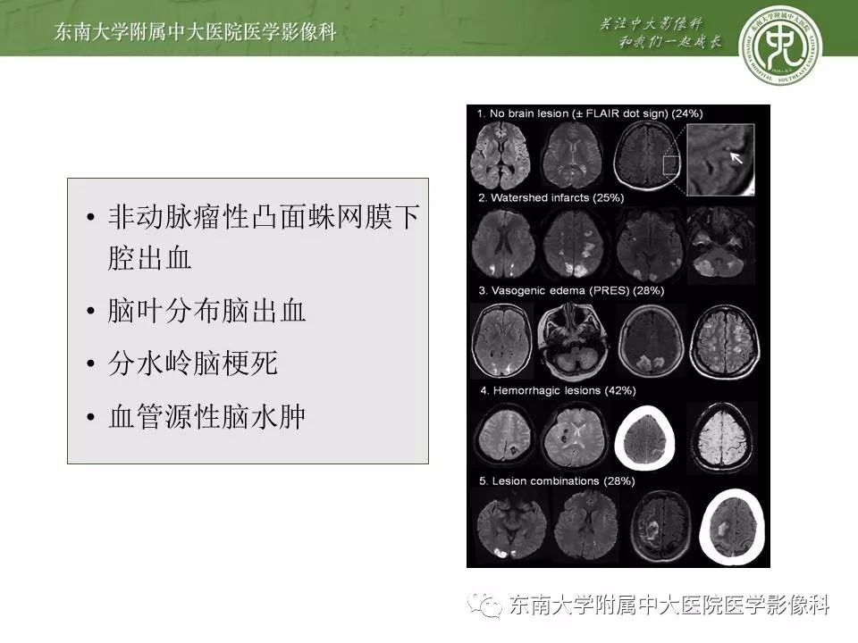 【病例】可逆性脑血管收缩综合征1例MR