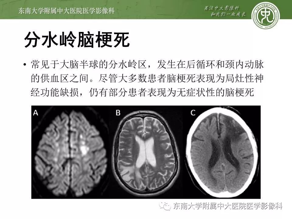 【病例】可逆性脑血管收缩综合征1例MR