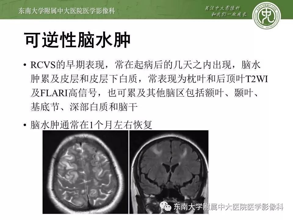【病例】可逆性脑血管收缩综合征1例MR