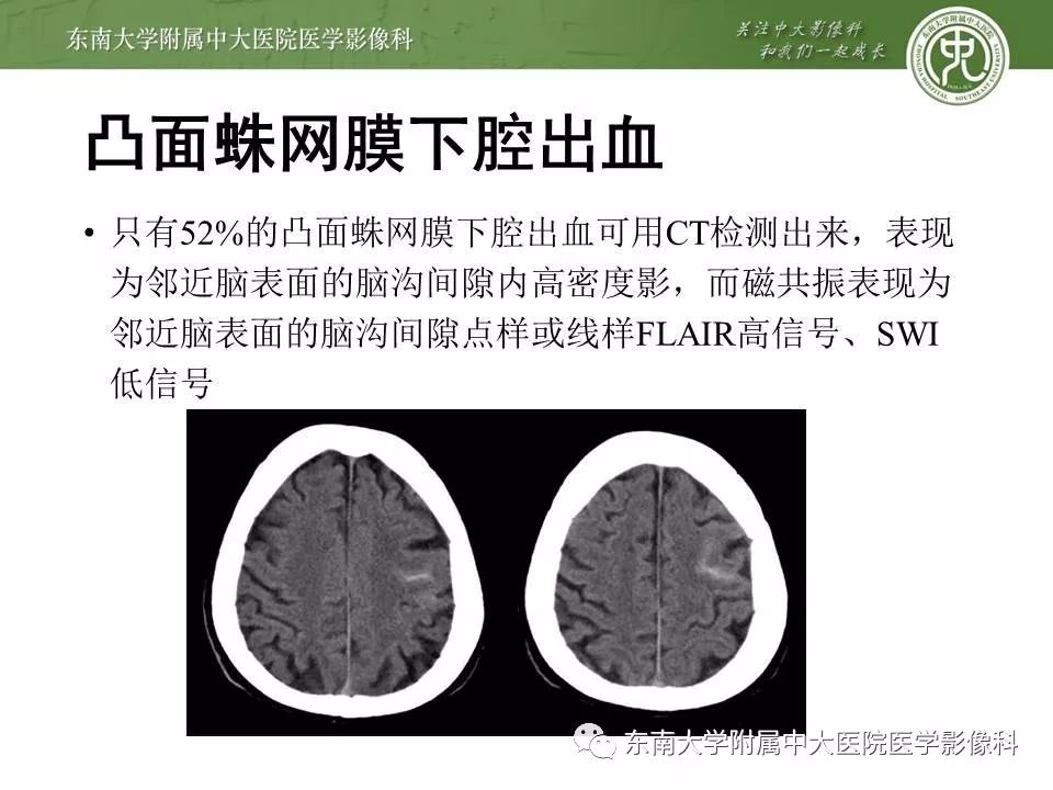【病例】可逆性脑血管收缩综合征1例MR