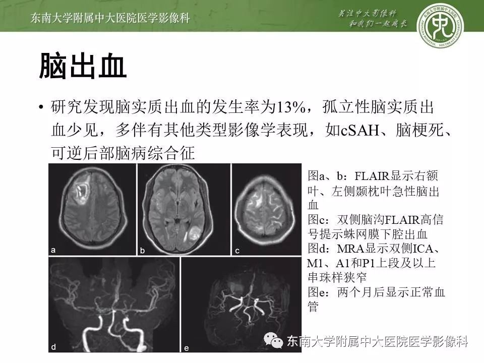 【病例】可逆性脑血管收缩综合征1例MR