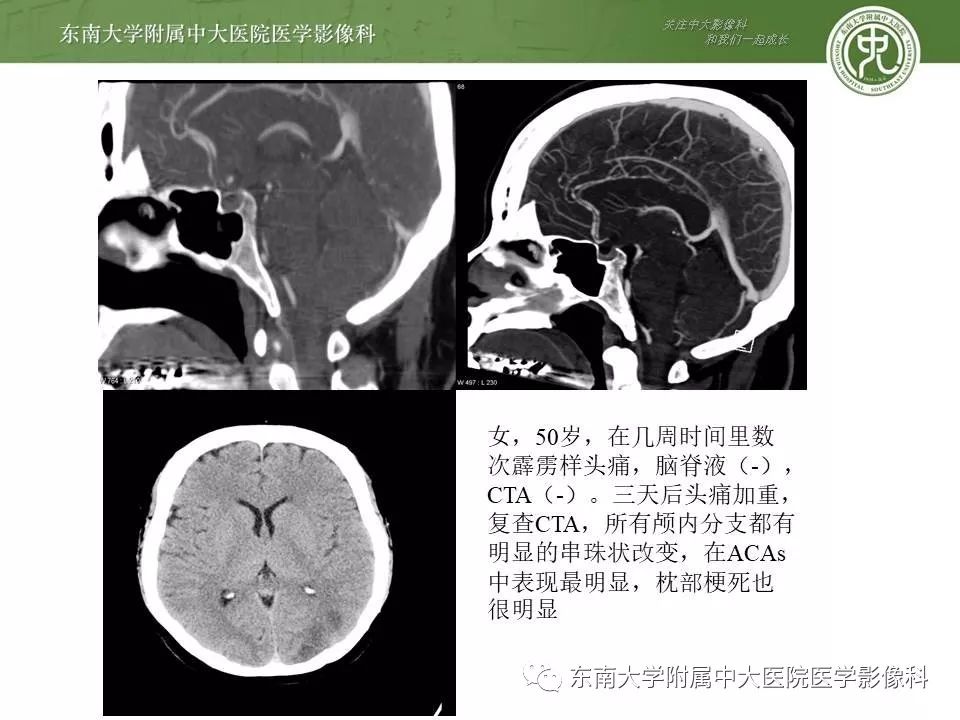 【病例】可逆性脑血管收缩综合征1例MR