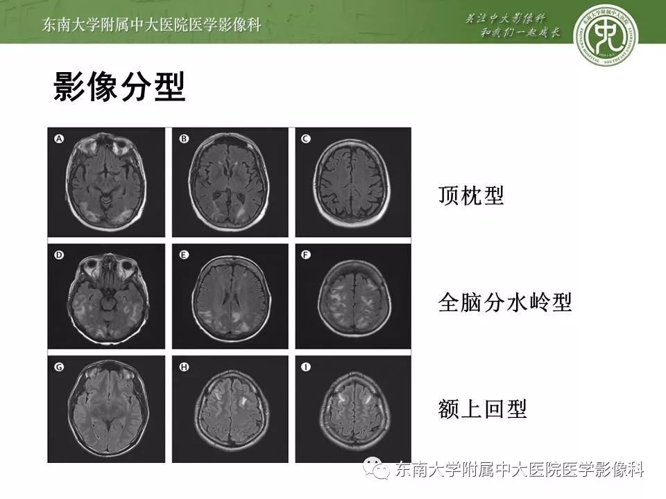 【病例】可逆性脑血管收缩综合征1例MR