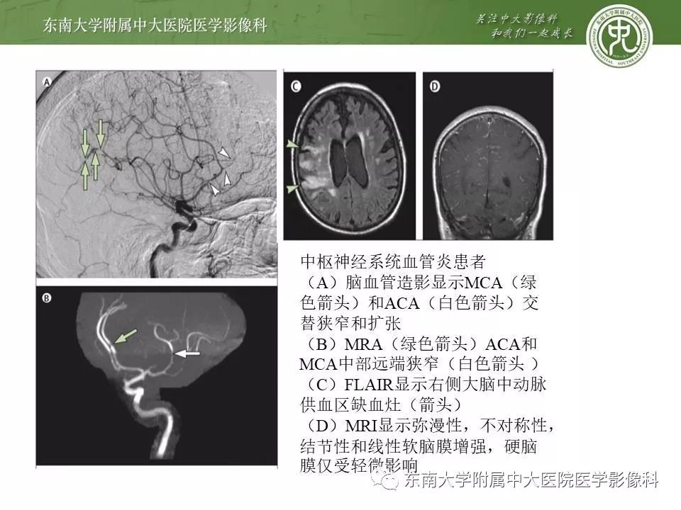 【病例】可逆性脑血管收缩综合征1例MR
