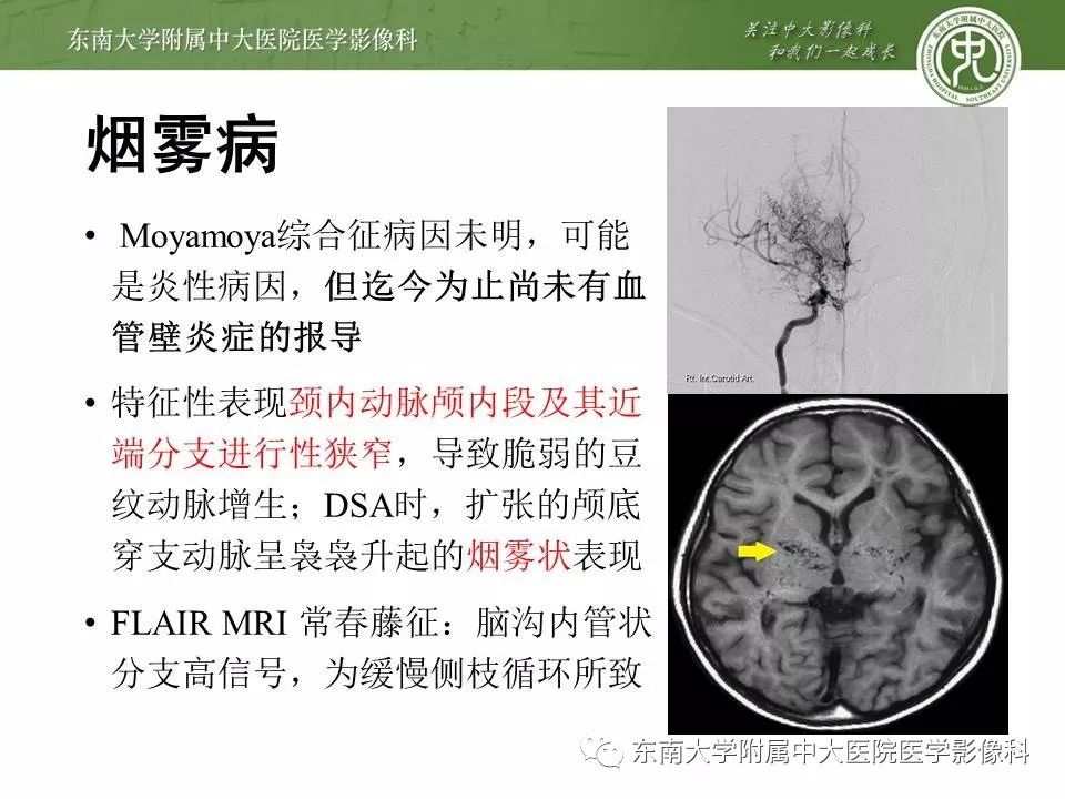 【病例】可逆性脑血管收缩综合征1例MR